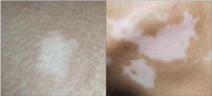 Skin Cover