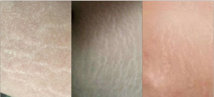Skin Cover
