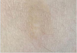 Skin Cover