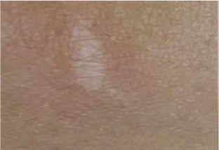 Skin Cover