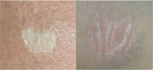 Skin Cover
