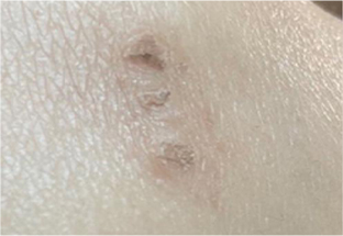 Skin Cover